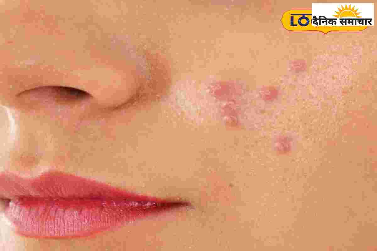 पिंपल से परेशान है आपका टीनएजर बच्चा, ये टुकड़ा एक हफ्ते में चमका देगा चेहरा