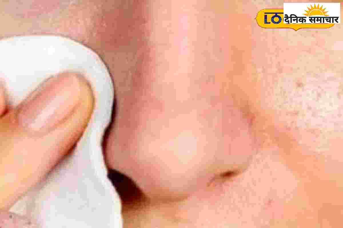 ब्लैकहेड्स ने बिगाड़ दिया है चेहरा, तो ये कारगर टिप्स आएंगे आपके काम